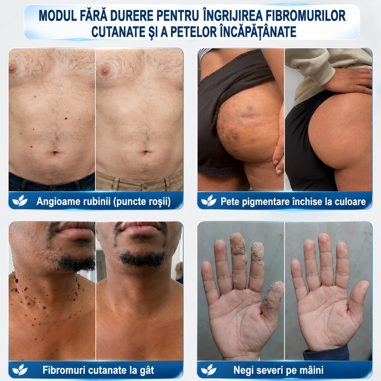 𝐌𝐚𝐠𝐚𝐳𝐢𝐧 𝐎𝐟𝐢𝐜𝐢𝐚𝐥 𝐚𝐥 𝐁𝐫𝐚𝐧𝐝𝐮𝐥𝐮𝐢 | ✅🛡️🛡️ 𝐏i𝐜𝐝o® 7 zile 𝗧𝐚𝐠 & 𝗦𝗽𝐨𝐭 𝐄𝐫𝒂𝒔𝒆𝒓 — roller pentru îngrijirea negilor, fibromelor cutanate și petelor pigmentare / fără durere, fără cicatrici